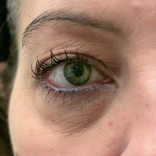 Antes - blefaroplastia