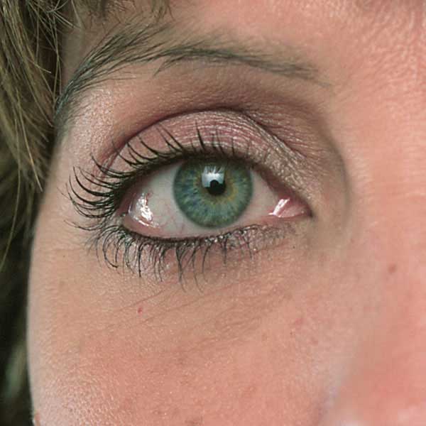 Después - blefaroplastia
