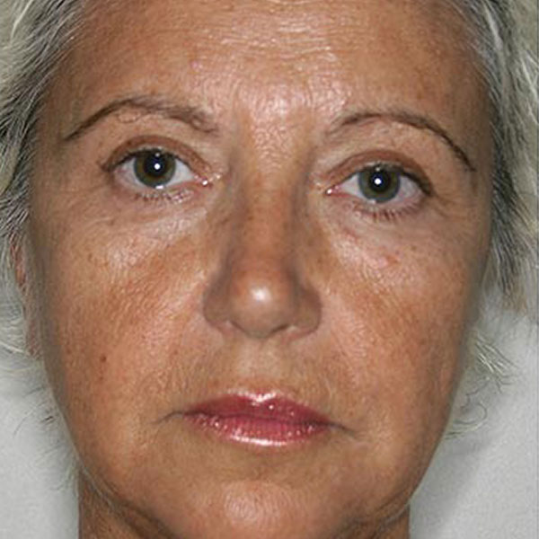 Antes - lifting cara cuello