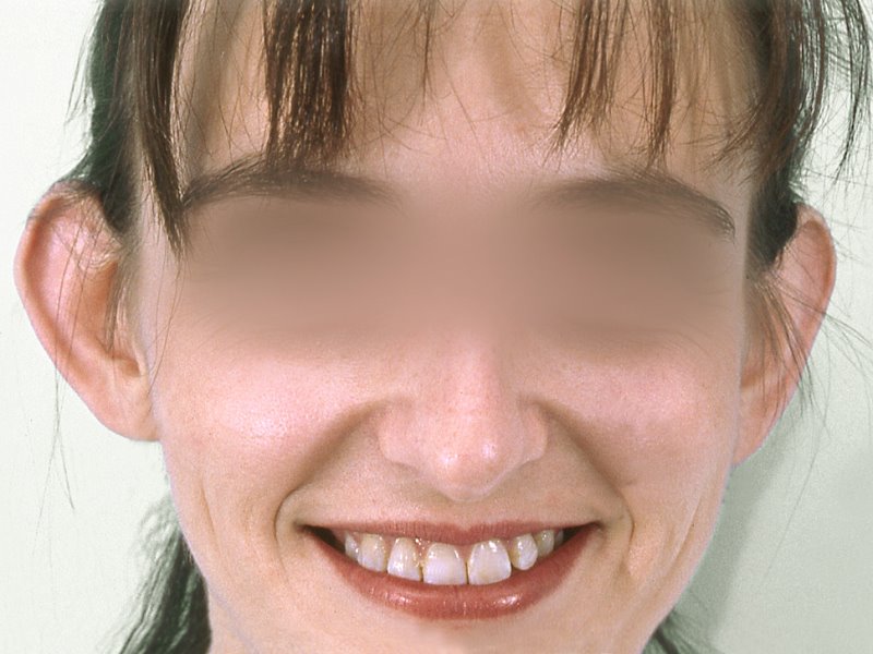 Antes - otoplastia