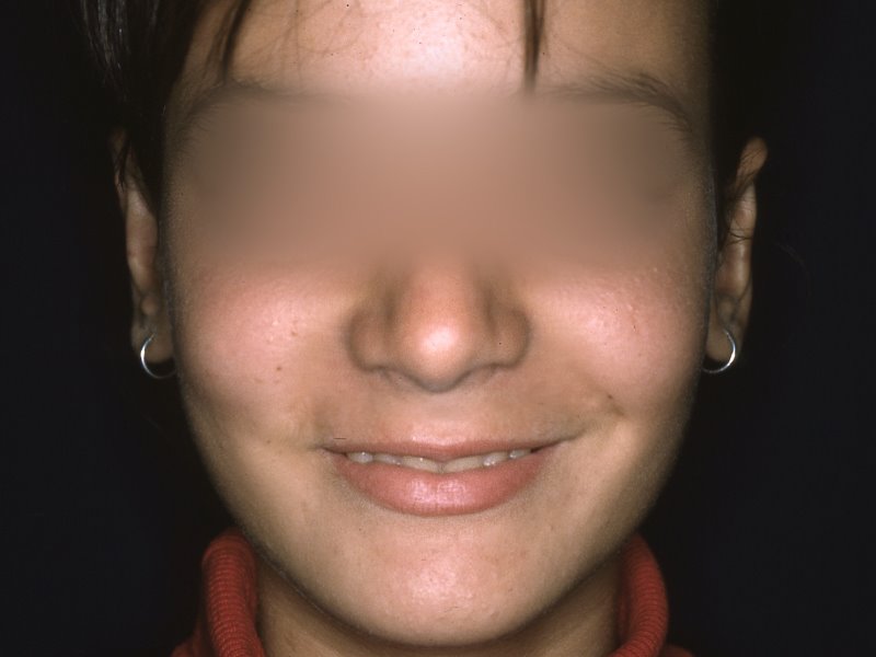 Después - otoplastia
