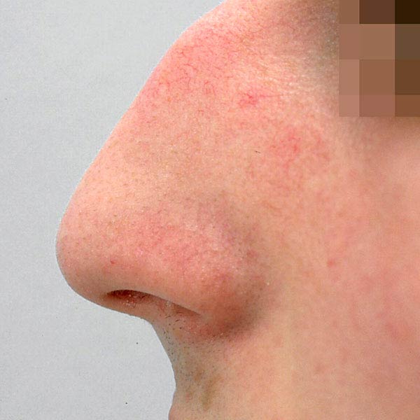rinoplastia cirugia de la nariz barcelona estetica antes 02
