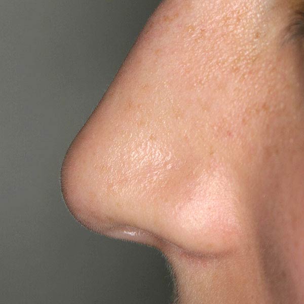 rinoplastia cirugia de la nariz barcelona estetica antes 03