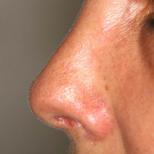 rinoplastia cirugia de la nariz barcelona estetica despues 01