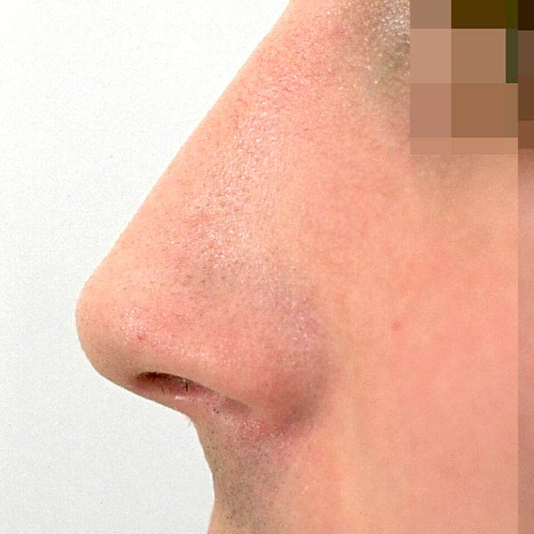 rinoplastia cirugia de la nariz barcelona estetica despues 02