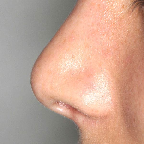 rinoplastia cirugia de la nariz barcelona estetica despues 03