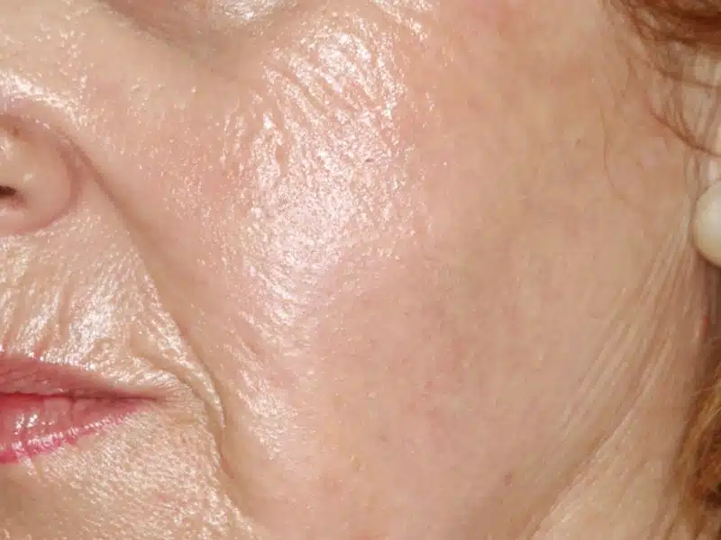 tratamiento de peeling facial despues de la intervención