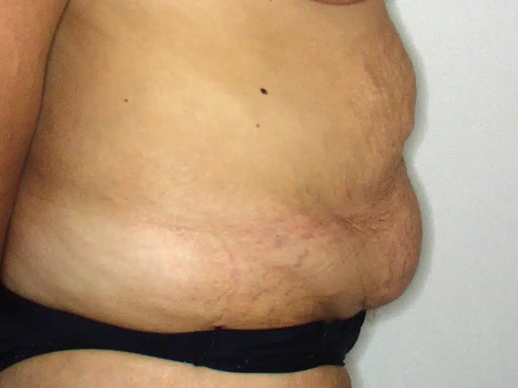 abdominoplastia intervención quirúrgica antes