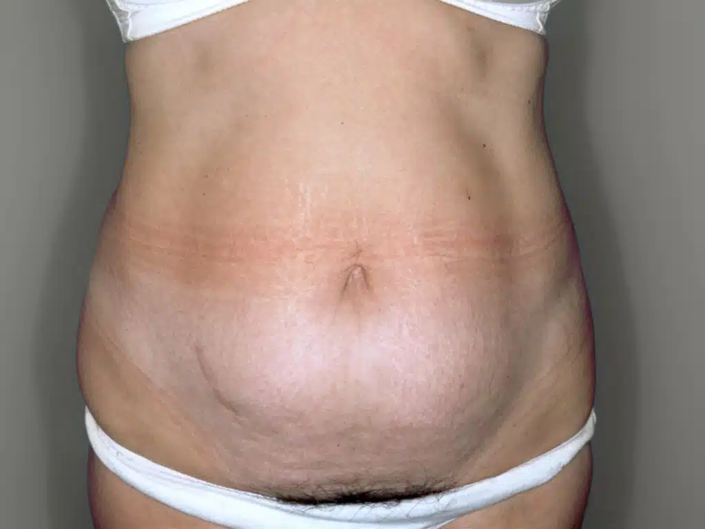 abdominoplastia tratamiento imágenes antes y después
